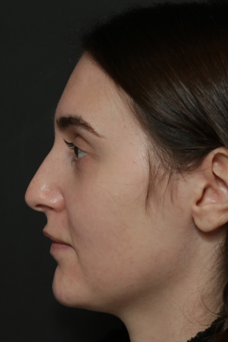 Rhinoplasty Before and After | Dr. Ashlin Alexander