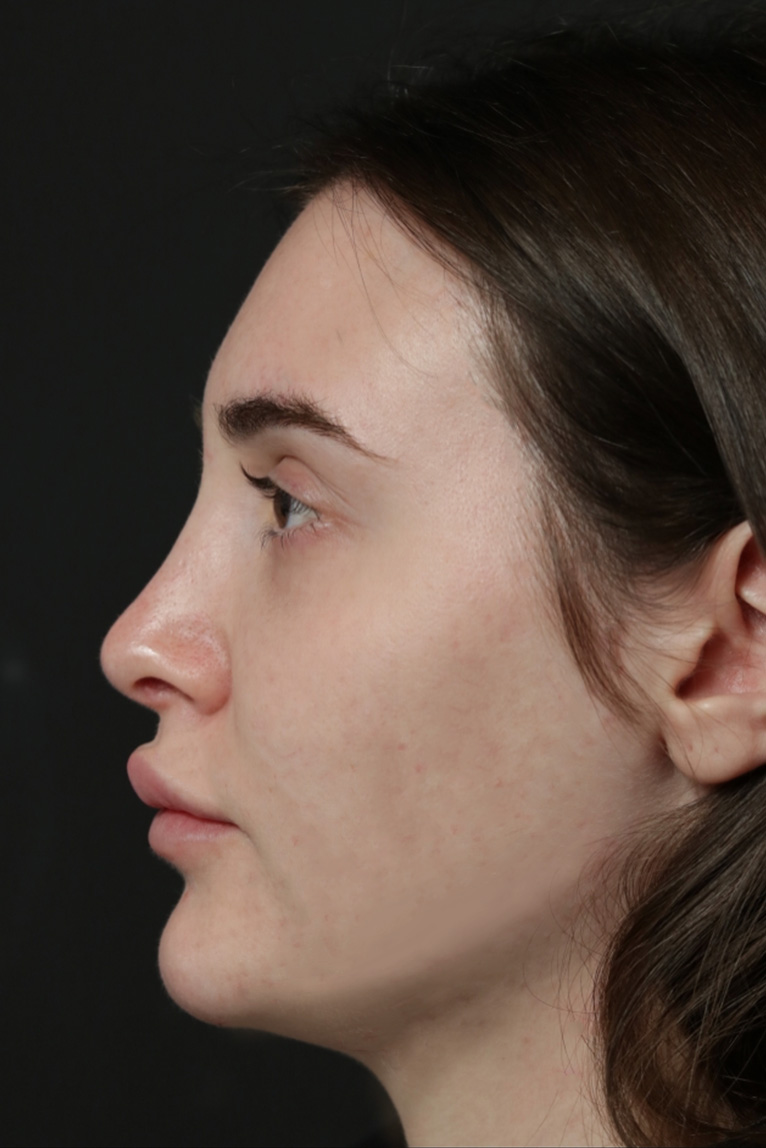 Rhinoplasty Before and After | Dr. Ashlin Alexander
