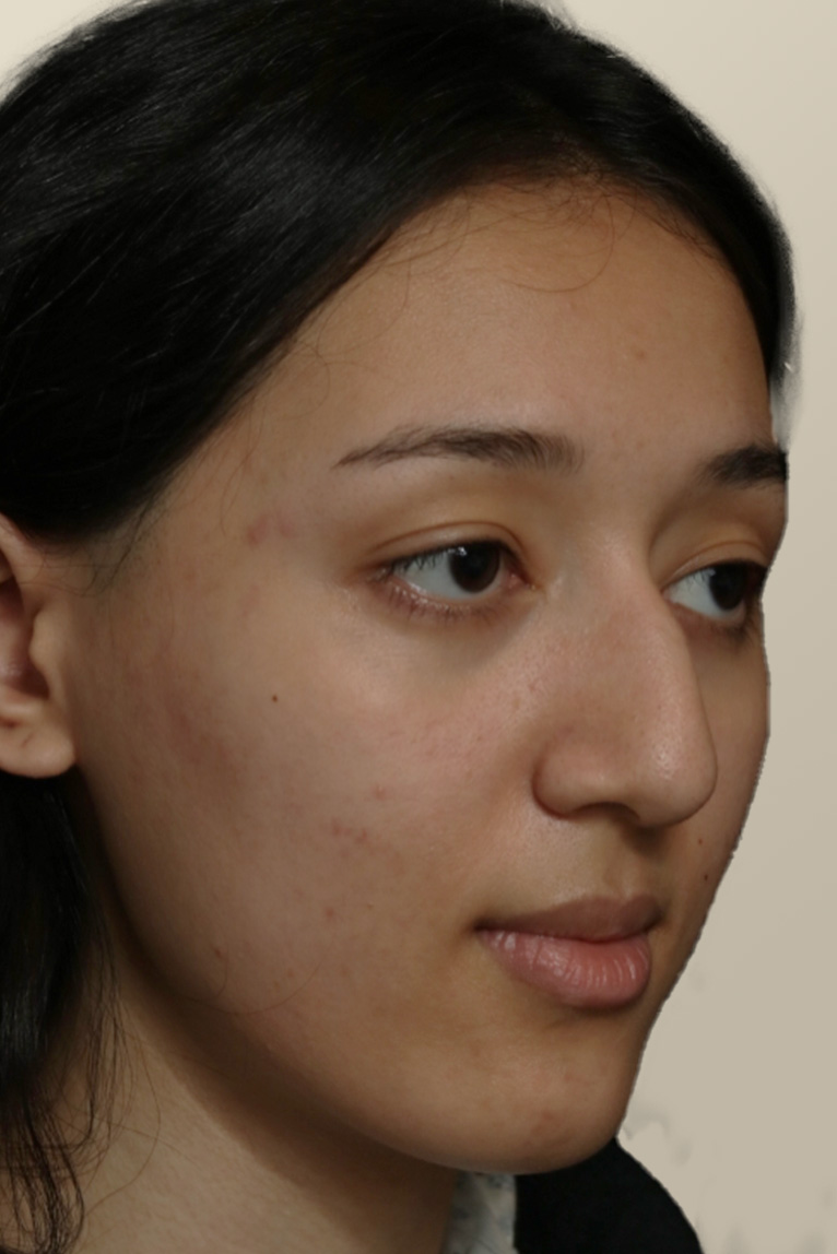 Rhinoplasty Before and After | Dr. Ashlin Alexander