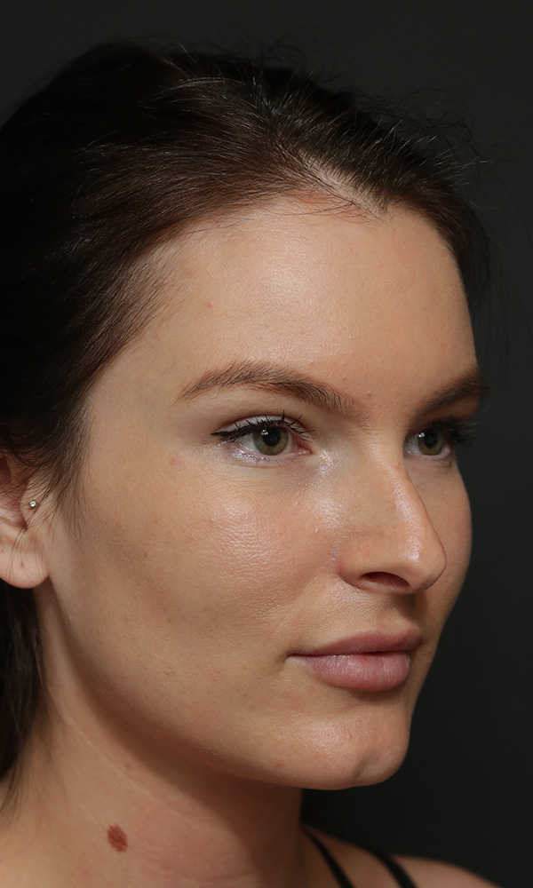 Rhinoplasty Before and After | Dr. Ashlin Alexander