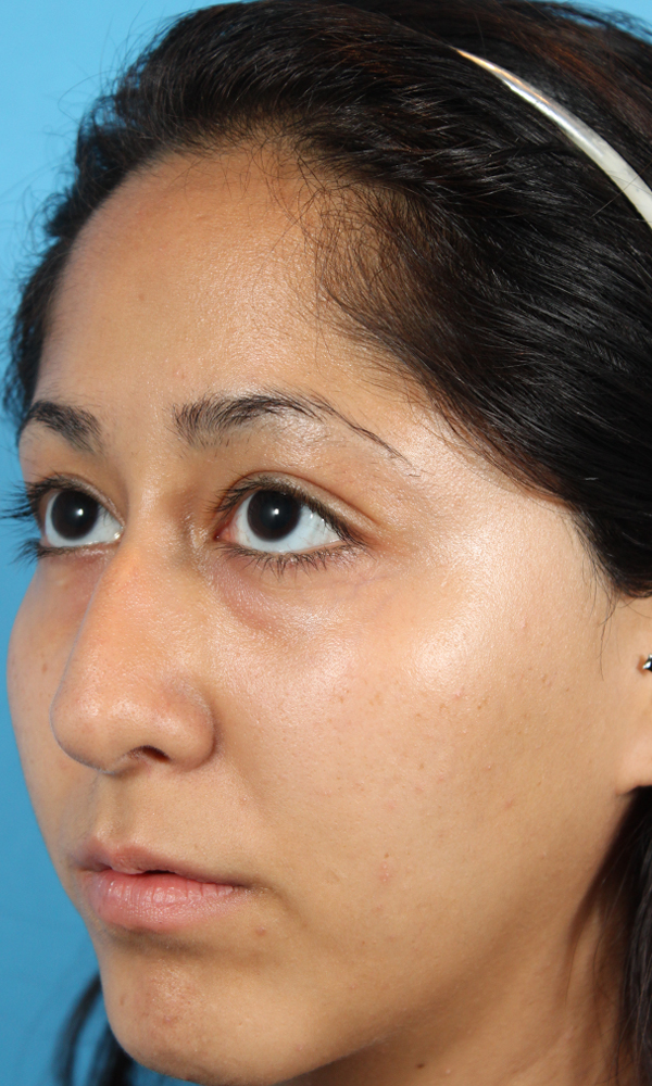 Rhinoplasty Before and After | Dr. Ashlin Alexander
