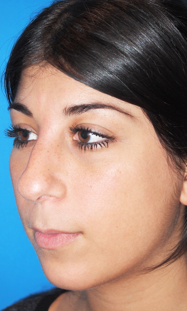 Rhinoplasty Before and After | Dr. Ashlin Alexander
