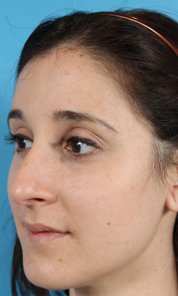 Rhinoplasty Before and After | Dr. Ashlin Alexander