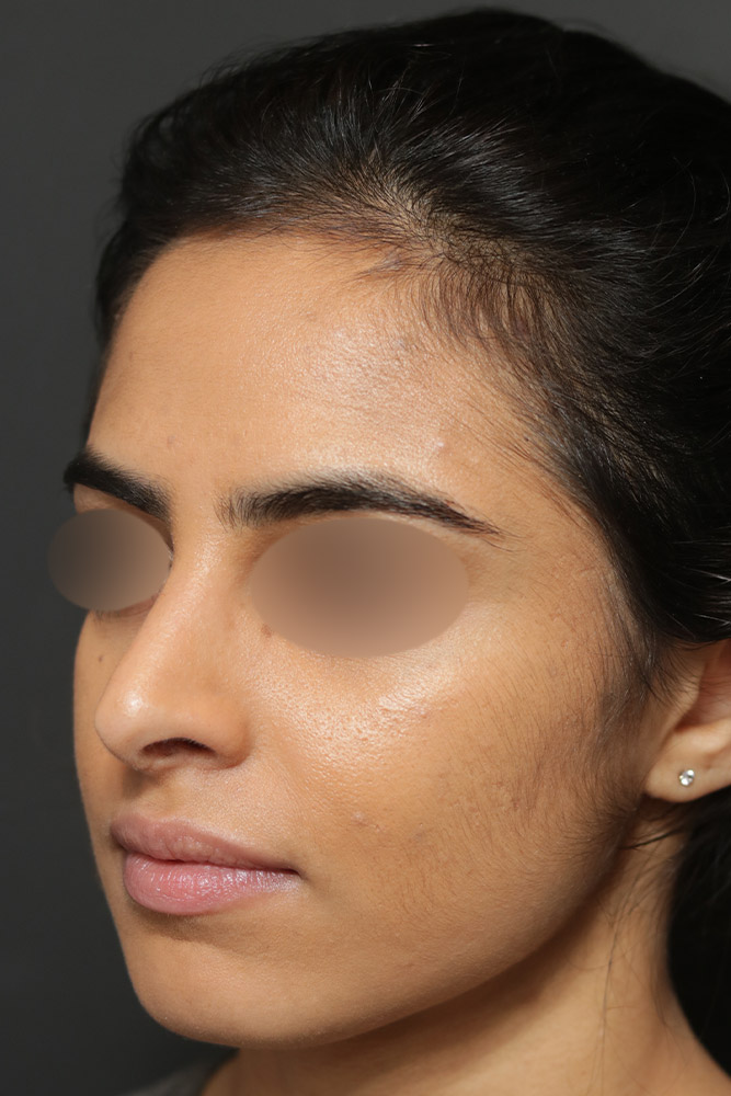 Rhinoplasty Before and After | Dr. Ashlin Alexander