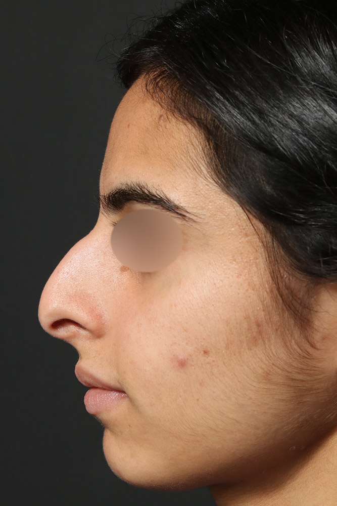 Rhinoplasty Before and After | Dr. Ashlin Alexander