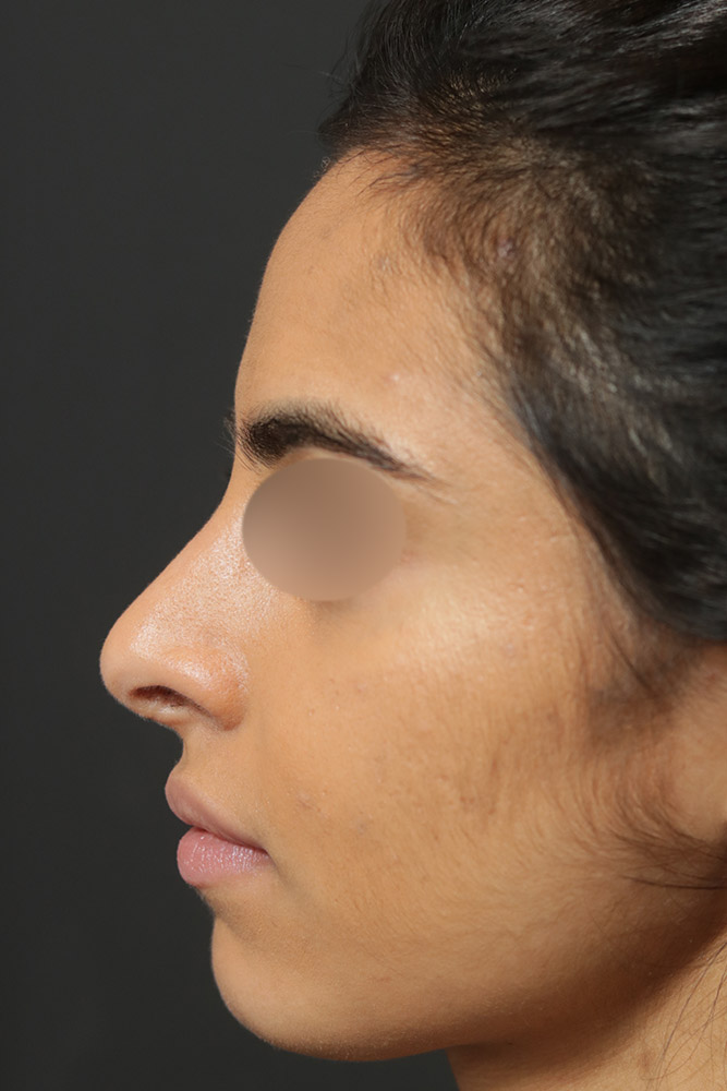 Rhinoplasty Before and After | Dr. Ashlin Alexander