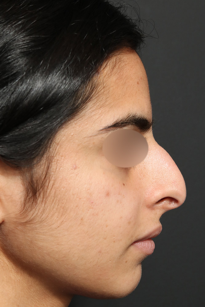 Rhinoplasty Before and After | Dr. Ashlin Alexander