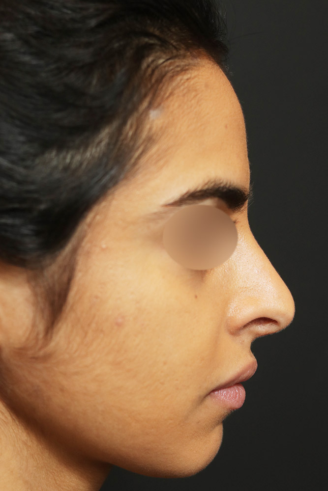 Rhinoplasty Before and After | Dr. Ashlin Alexander