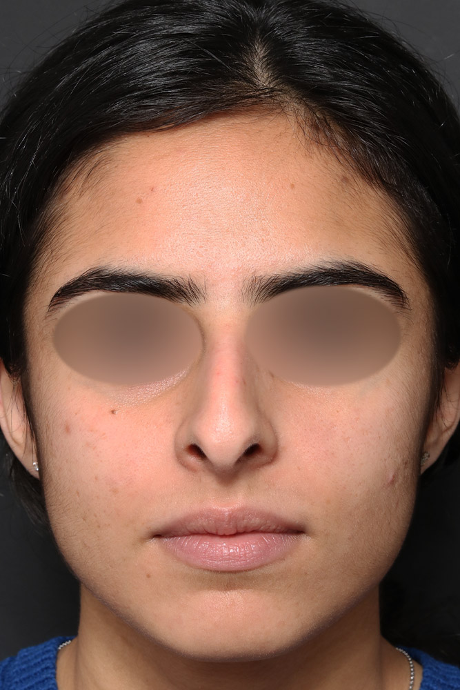 Rhinoplasty Before and After | Dr. Ashlin Alexander