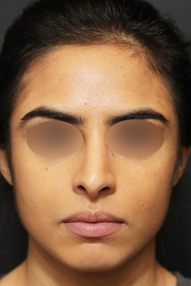 Rhinoplasty Before and After | Dr. Ashlin Alexander