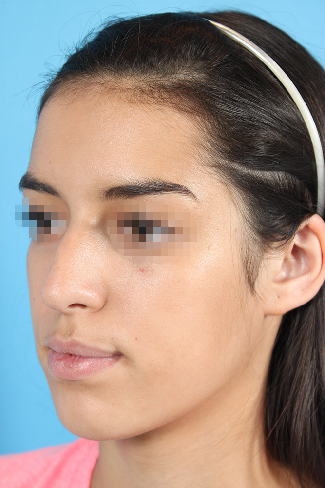 Rhinoplasty Before and After | Dr. Ashlin Alexander