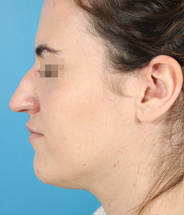 Rhinoplasty Before and After | Dr. Ashlin Alexander