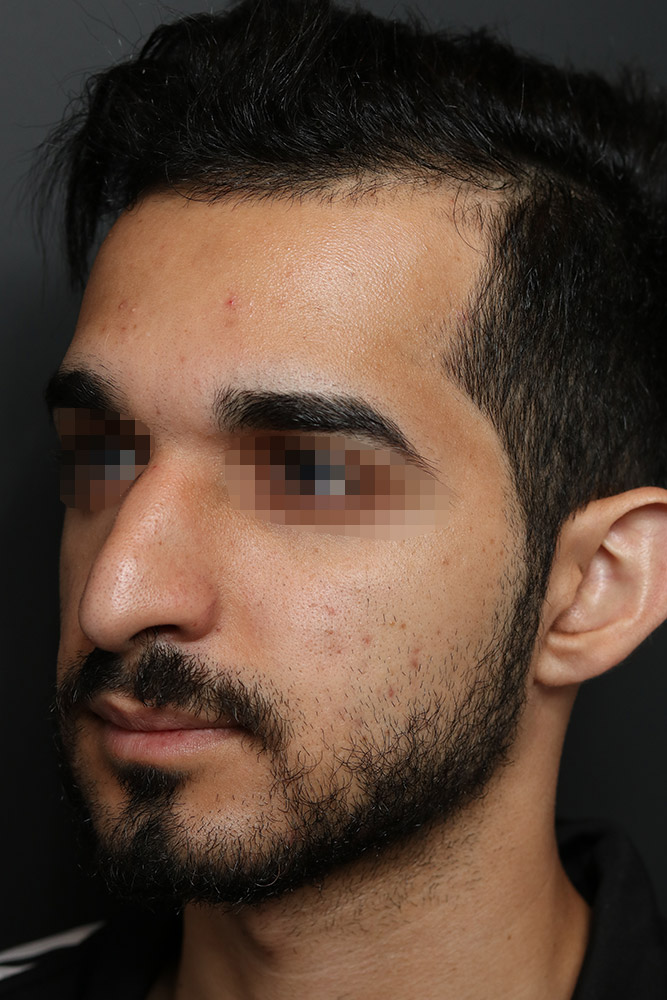 Rhinoplasty Before and After | Dr. Ashlin Alexander