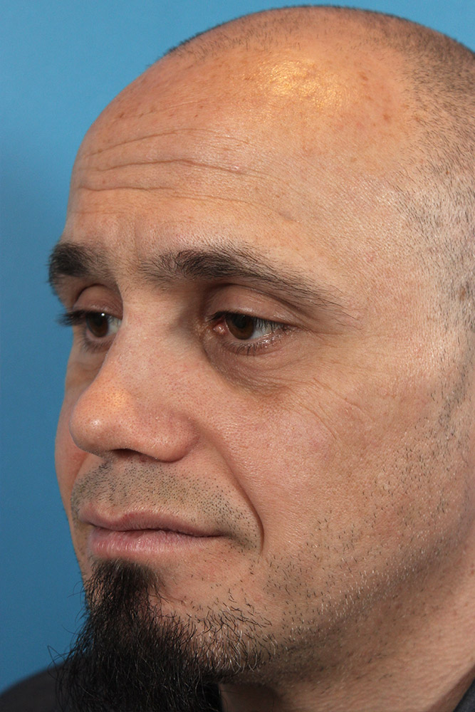 Rhinoplasty Before and After | Dr. Ashlin Alexander