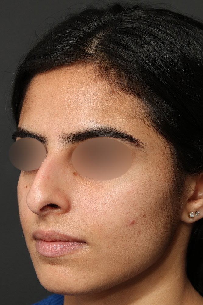 Rhinoplasty Before and After | Dr. Ashlin Alexander
