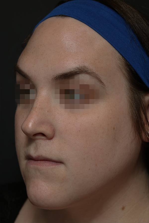 Rhinoplasty Before and After | Dr. Ashlin Alexander