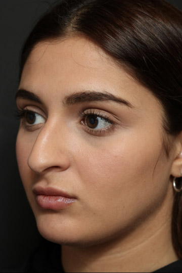 Rhinoplasty Before and After | Dr. Ashlin Alexander