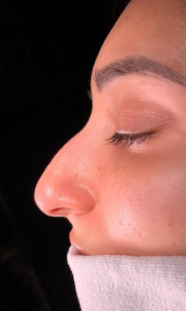 Rhinoplasty Before and After | Dr. Ashlin Alexander