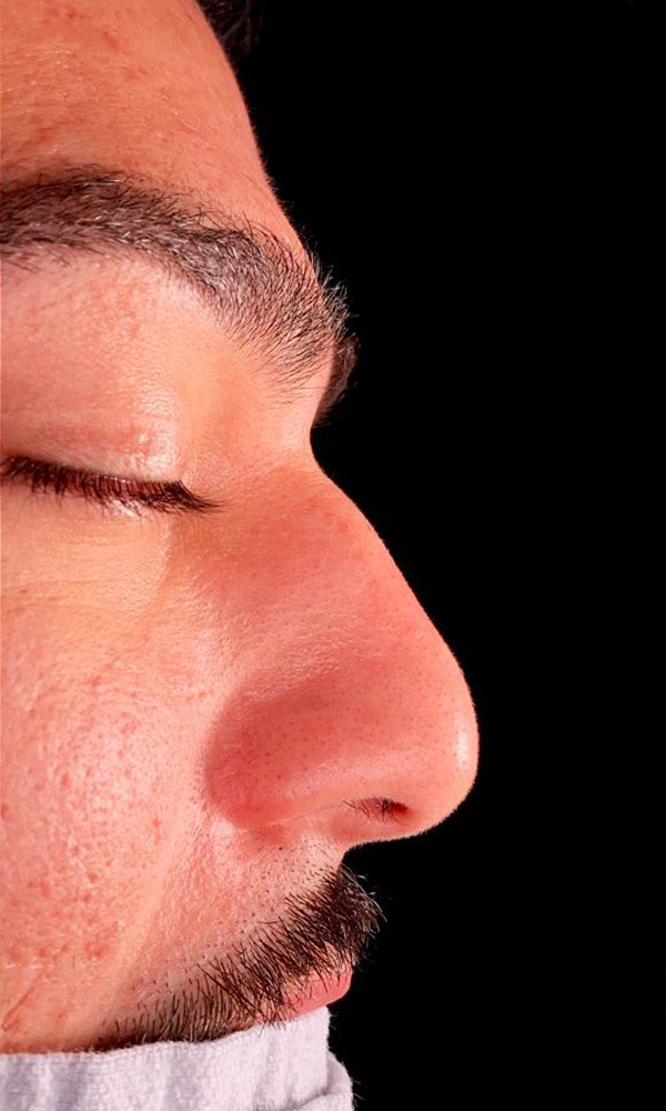 Rhinoplasty Before and After | Dr. Ashlin Alexander