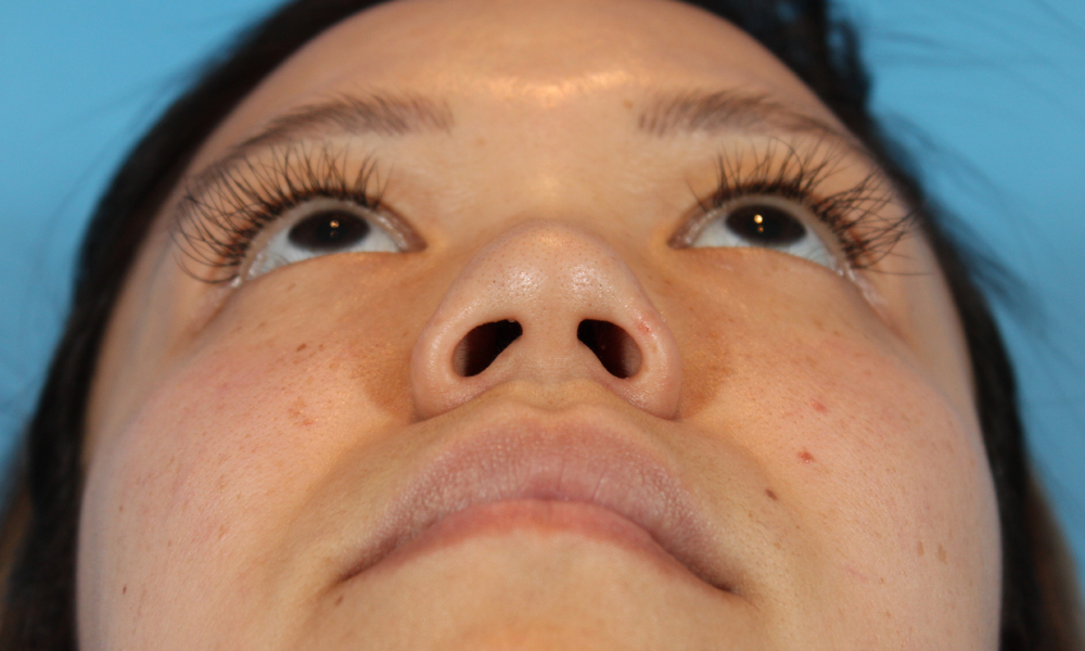 Non Surgical Rhinoplasty Before and After | Dr. Ashlin Alexander