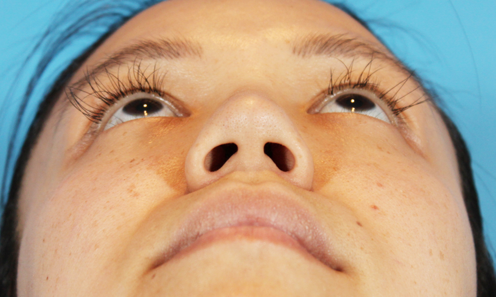 Non Surgical Rhinoplasty Before and After | Dr. Ashlin Alexander