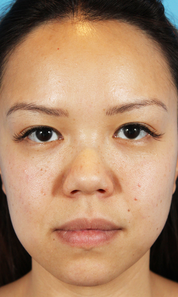 Non Surgical Rhinoplasty Before and After | Dr. Ashlin Alexander