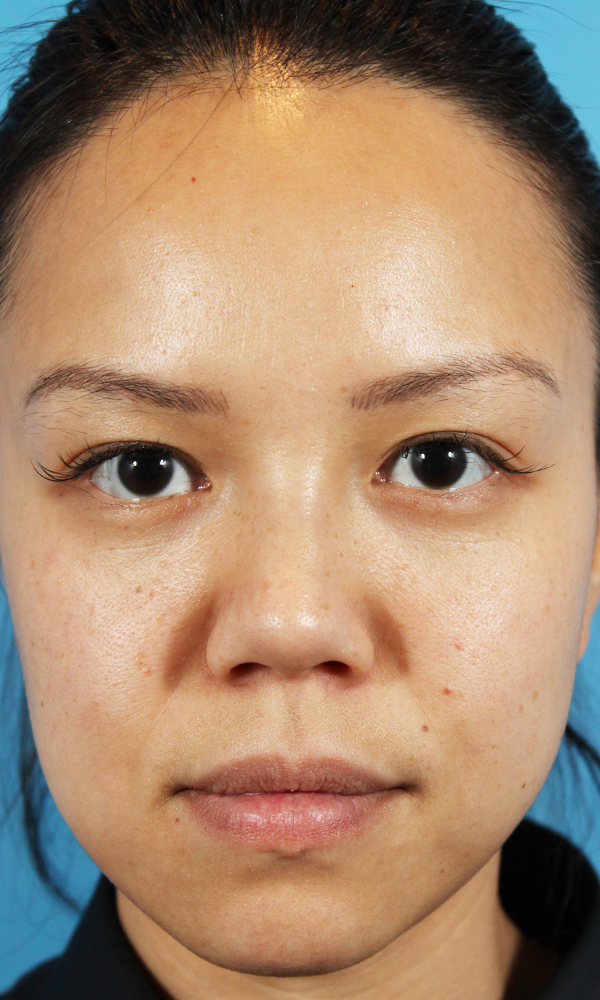 Non Surgical Rhinoplasty Before and After | Dr. Ashlin Alexander