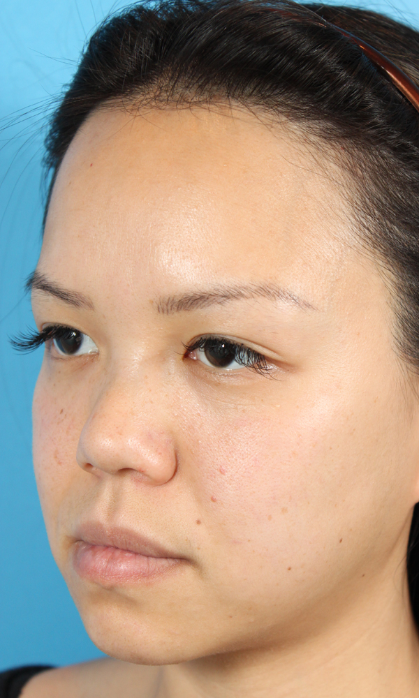 Non Surgical Rhinoplasty Before and After | Dr. Ashlin Alexander