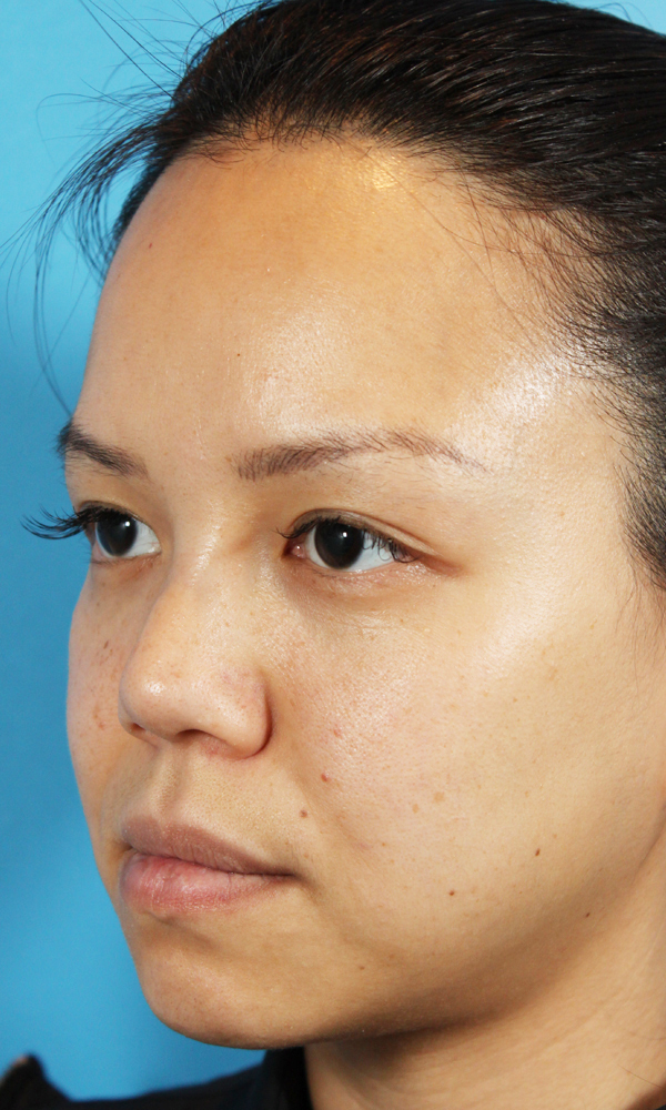 Non Surgical Rhinoplasty Before and After | Dr. Ashlin Alexander
