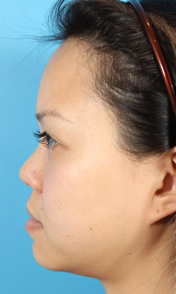 Non Surgical Rhinoplasty Before and After | Dr. Ashlin Alexander