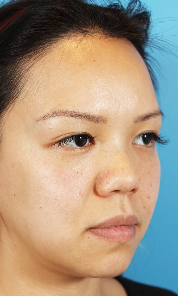 Non Surgical Rhinoplasty Before and After | Dr. Ashlin Alexander