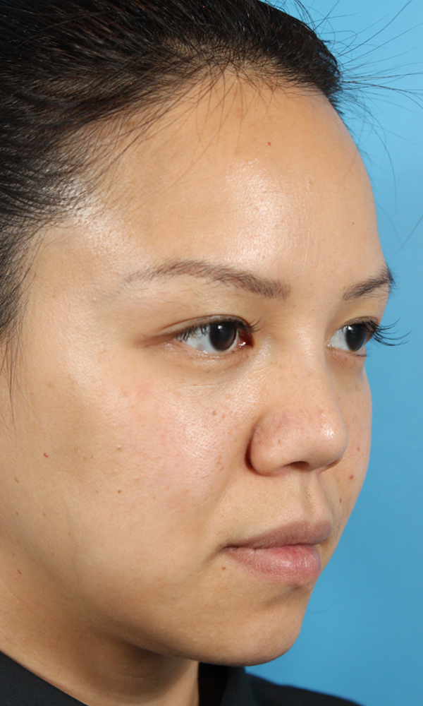 Non Surgical Rhinoplasty Before and After | Dr. Ashlin Alexander
