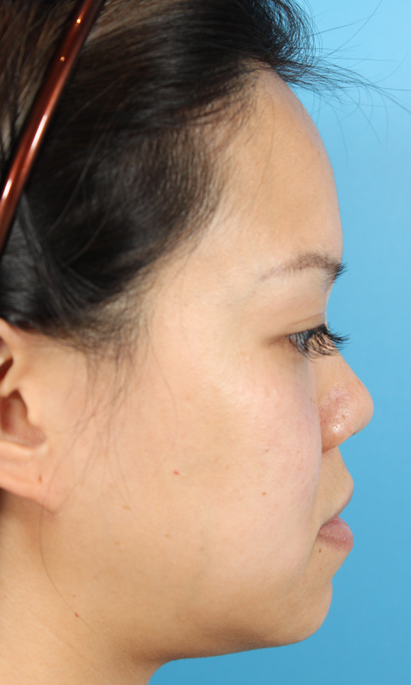 Non Surgical Rhinoplasty Before and After | Dr. Ashlin Alexander