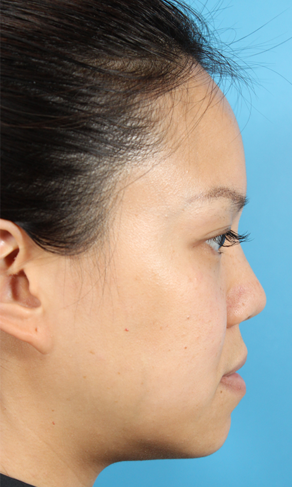Non Surgical Rhinoplasty Before and After | Dr. Ashlin Alexander