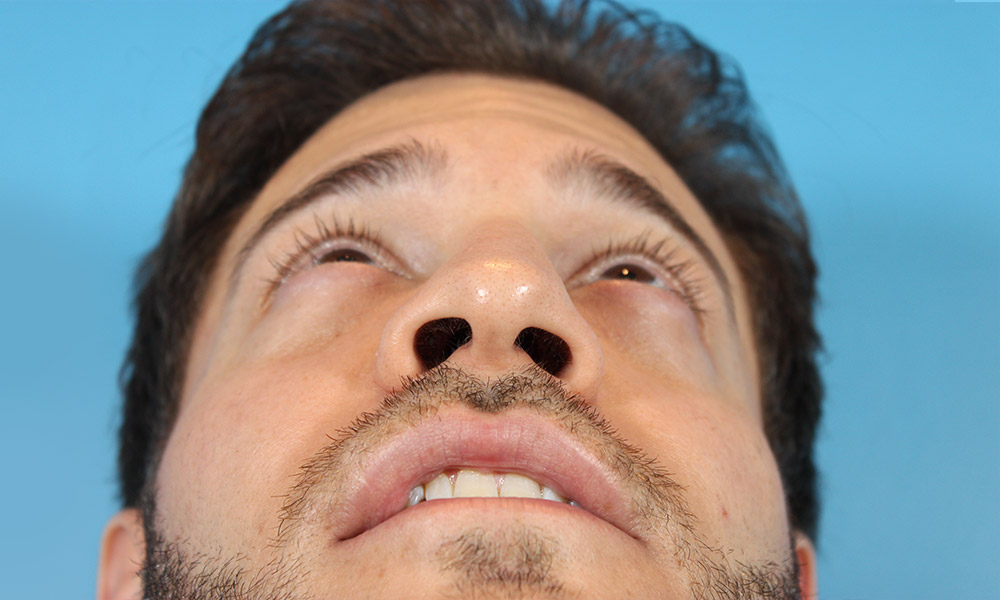 Non Surgical Rhinoplasty Before and After | Dr. Ashlin Alexander