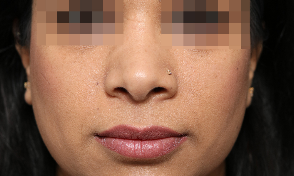 Non Surgical Rhinoplasty Before and After | Dr. Ashlin Alexander