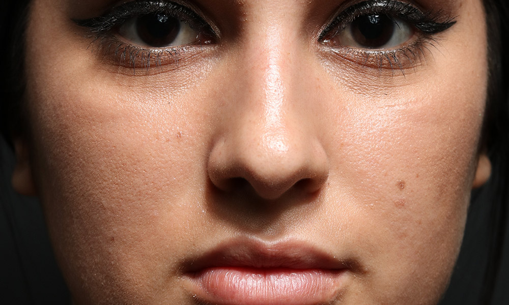 Non Surgical Rhinoplasty Before and After | Dr. Ashlin Alexander