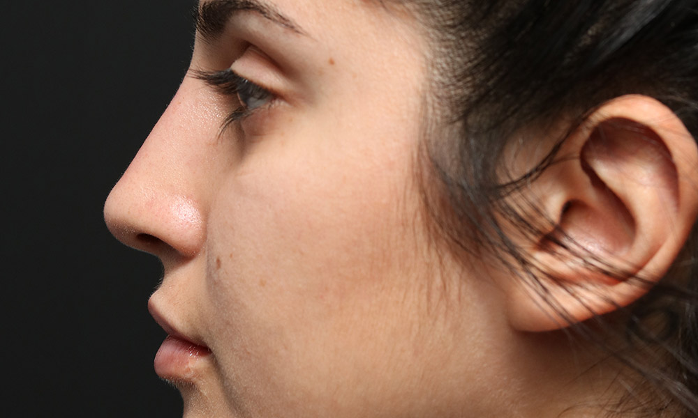 Non Surgical Rhinoplasty Before and After | Dr. Ashlin Alexander