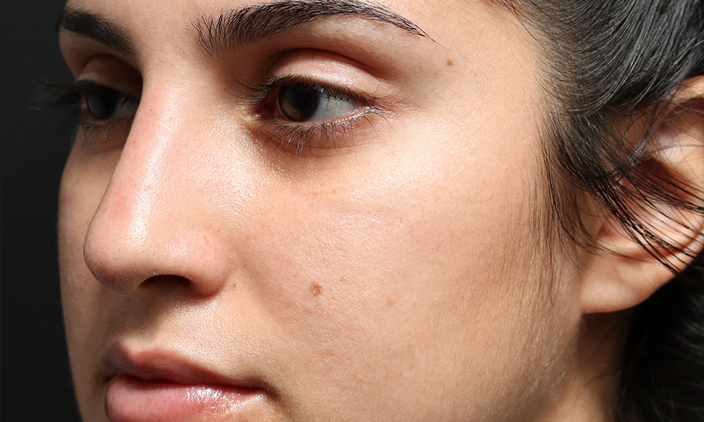 Non Surgical Rhinoplasty Before and After | Dr. Ashlin Alexander