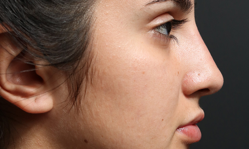 Non Surgical Rhinoplasty Before and After | Dr. Ashlin Alexander