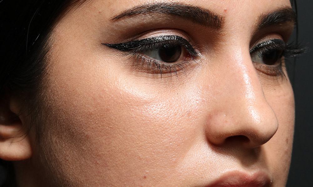 Non Surgical Rhinoplasty Before and After | Dr. Ashlin Alexander