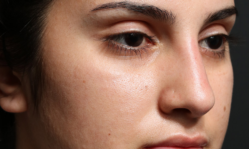 Non Surgical Rhinoplasty Before and After | Dr. Ashlin Alexander