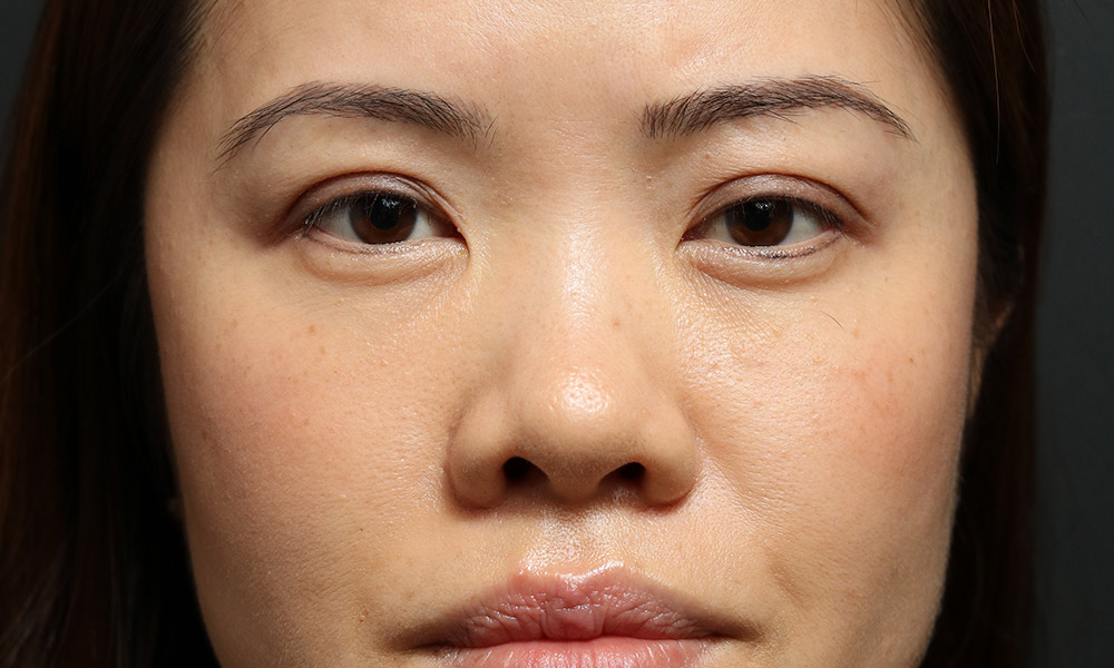 Non Surgical Rhinoplasty Before and After | Dr. Ashlin Alexander