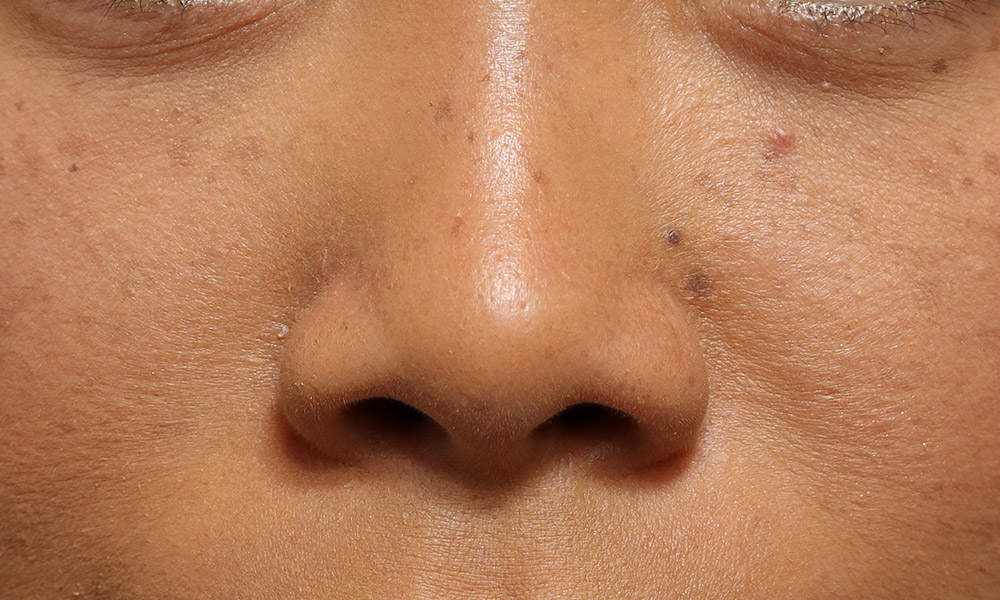 Non Surgical Rhinoplasty Before and After | Dr. Ashlin Alexander