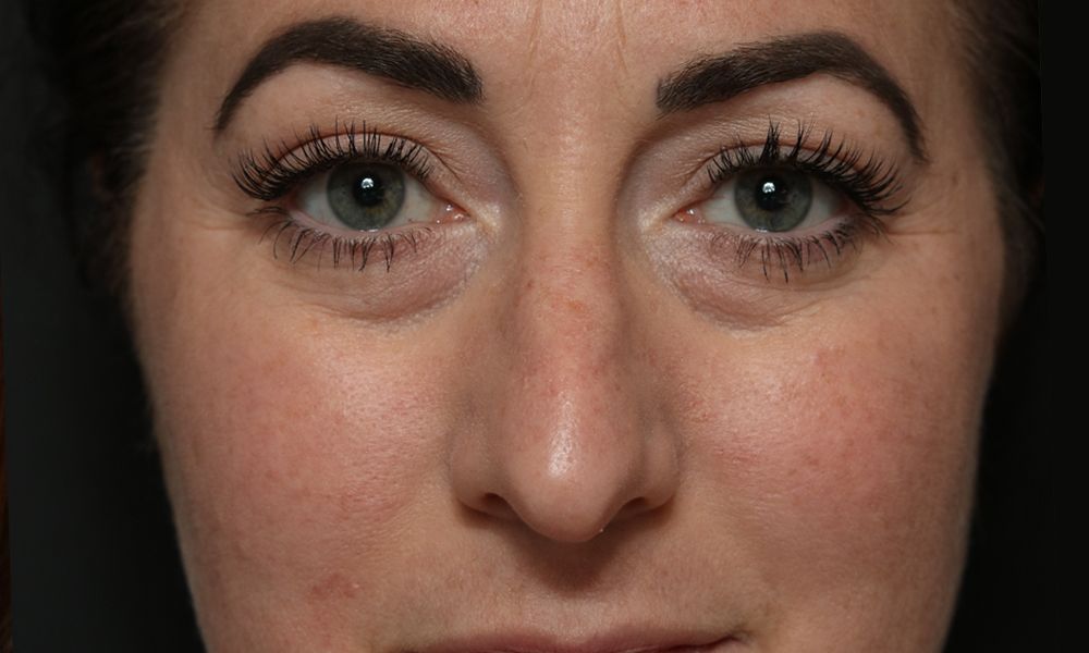 Non Surgical Rhinoplasty Before and After | Dr. Ashlin Alexander