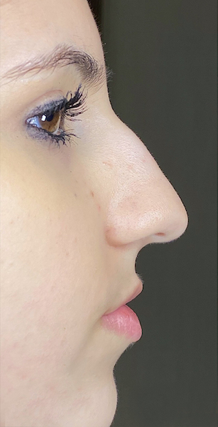 Non Surgical Rhinoplasty Before and After | Dr. Ashlin Alexander