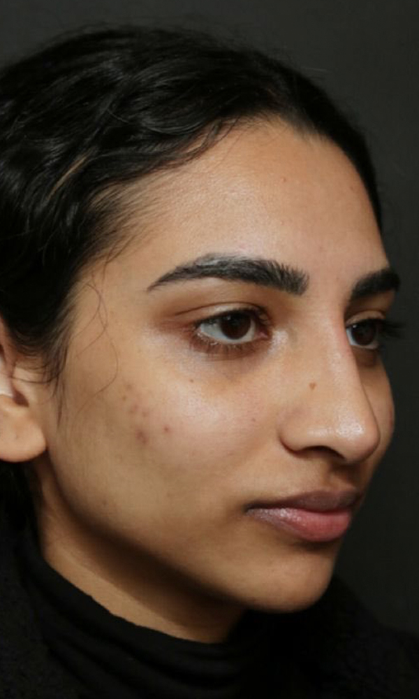 Non Surgical Rhinoplasty Before and After | Dr. Ashlin Alexander