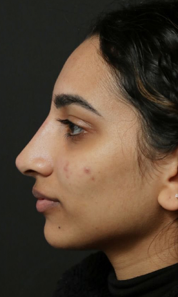 Non Surgical Rhinoplasty Before and After | Dr. Ashlin Alexander