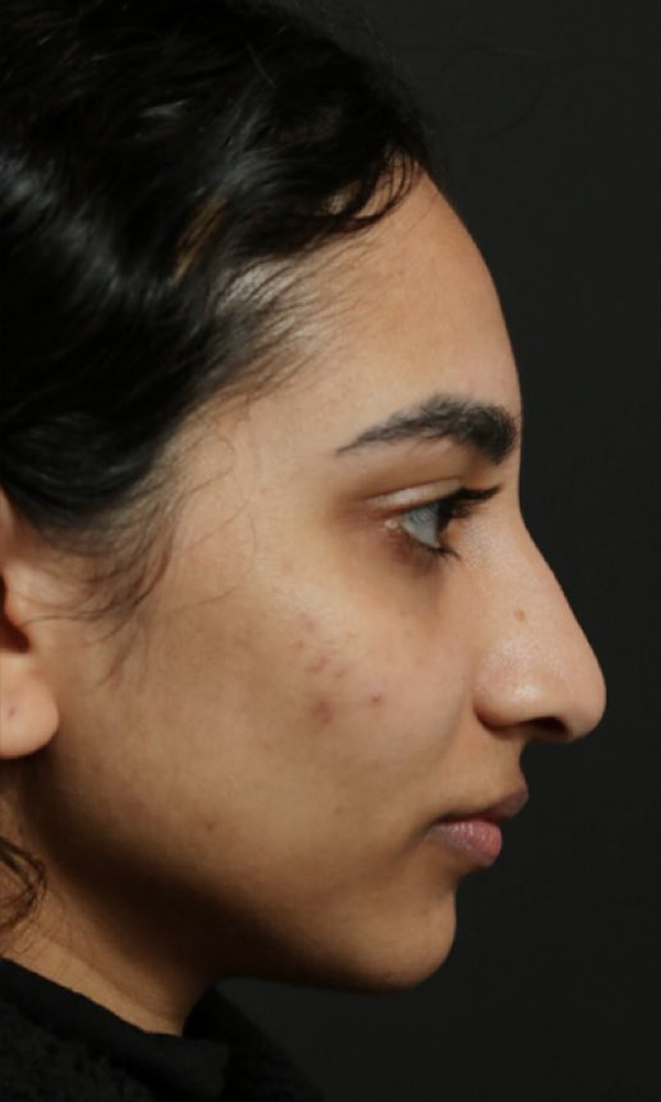 Non Surgical Rhinoplasty Before and After | Dr. Ashlin Alexander