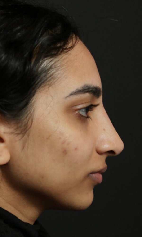 Non Surgical Rhinoplasty Before and After | Dr. Ashlin Alexander